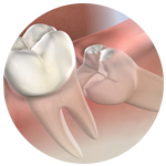extracción de cordales