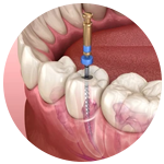 tratamiento de canales