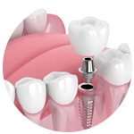 implantes dentales.png