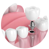 implantes dentales